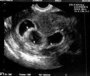  8 weeks ultrasound!!