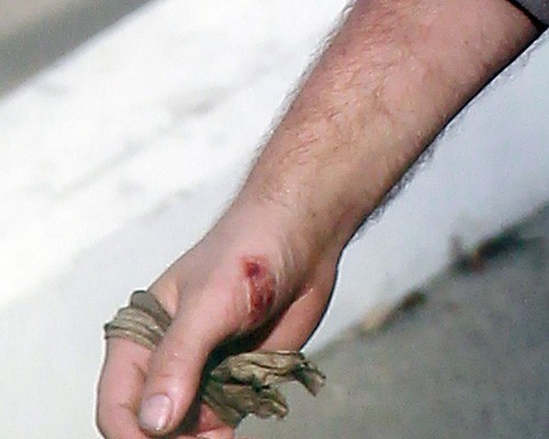  Robert Pattinson with his bitten hand on the set of "Water for Elephants" (July 28).