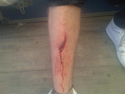  Sean cut his leg on stage when he fell on the drum riser. How many stitches did he have to get?