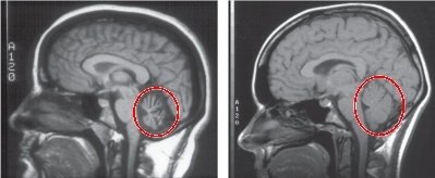  this picture shows the cerebellum (inside red circle) in two different people, the one on the right is a healthy one, this stays like this for all our lives, the one on the left is rapidly ''shrinking'' and there are clearly less neurons.