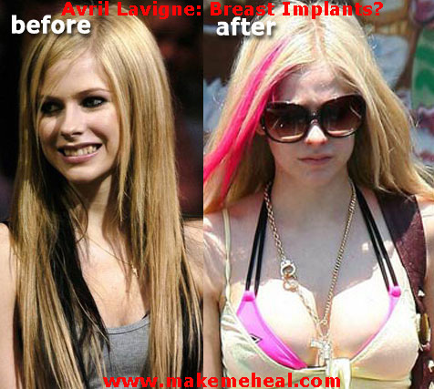  before and after avril